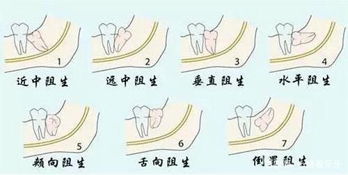 發(fā)炎的智齒什么時候拔才好？有些情況不能拔