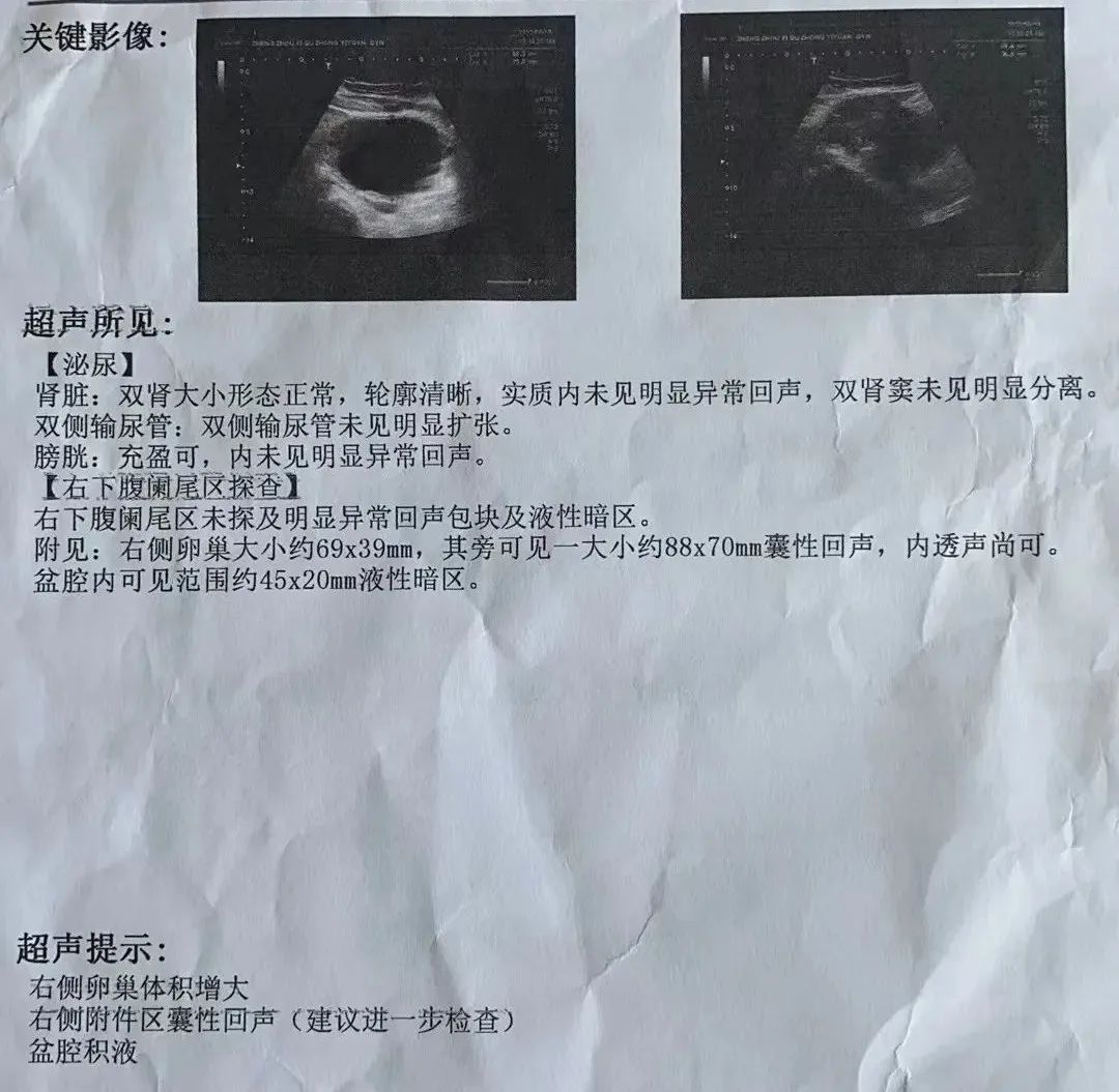 11歲女孩急性腹痛！竟然是卵巢囊腫蒂扭轉(zhuǎn)了